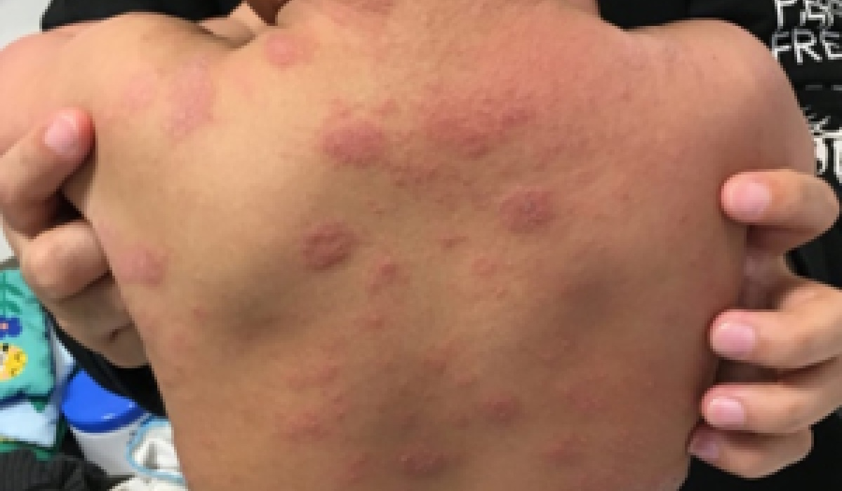 Eczema Common Health Issues Child 5 To 11 Years Healthier Together eczema-common-health-issues-child-5-to-11-years-healthier-together