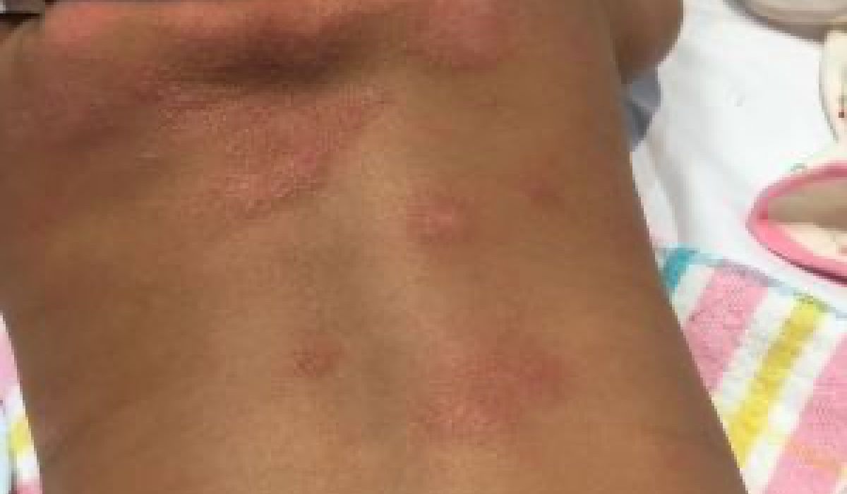 Eczema | Recent Illness or Concern | Healthier Together