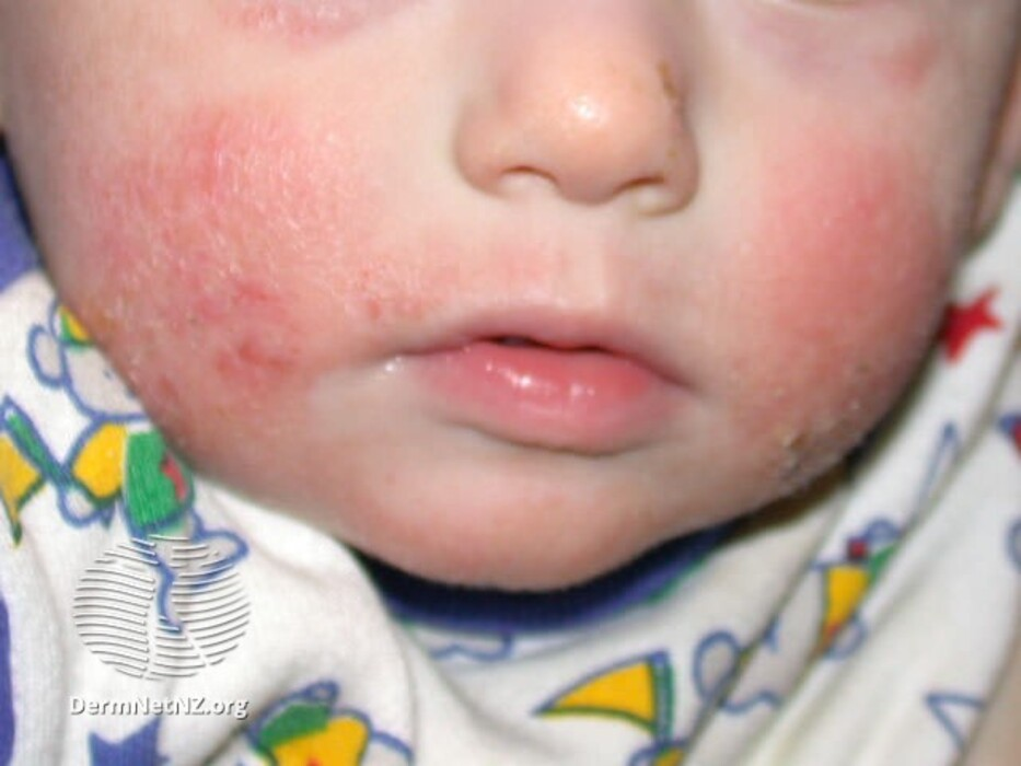 Skin Rashes In Babies Nhs How To Treat And Prevent Scabies In Humans