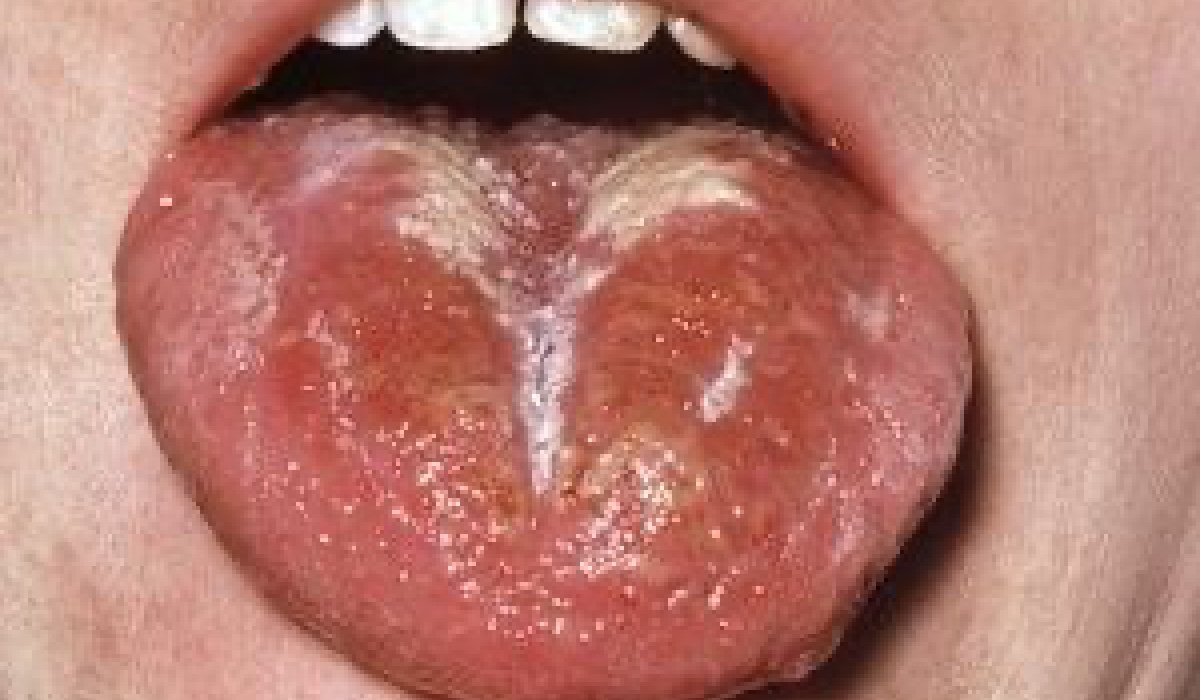 Scarlet fever or Scarlatina Scarlet Fever | Recent Illness or Concern | Scarlet fever - Scarlatina - Best treatment Option | Homeopathic | Best Homeopathic Doctor in Pakistan | Dr Qaisar Ahmed MD, DHMS